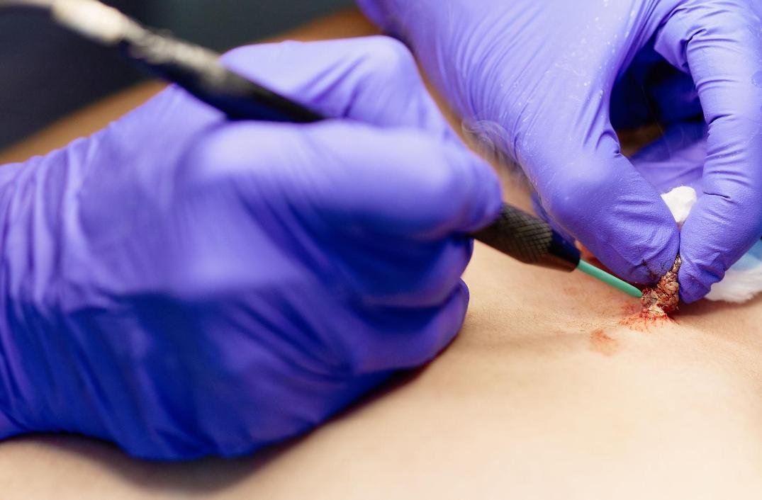 Mole, Cyst & Wart Removal example from the practice media library