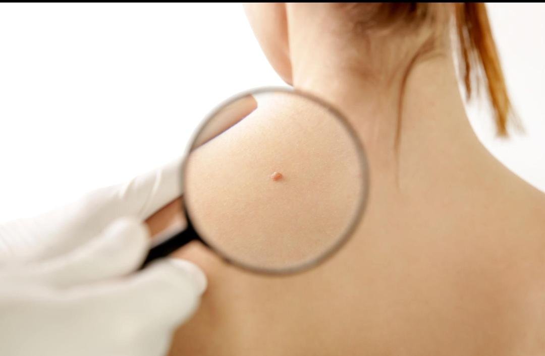 Editorial image representing mole, cyst & wart removal