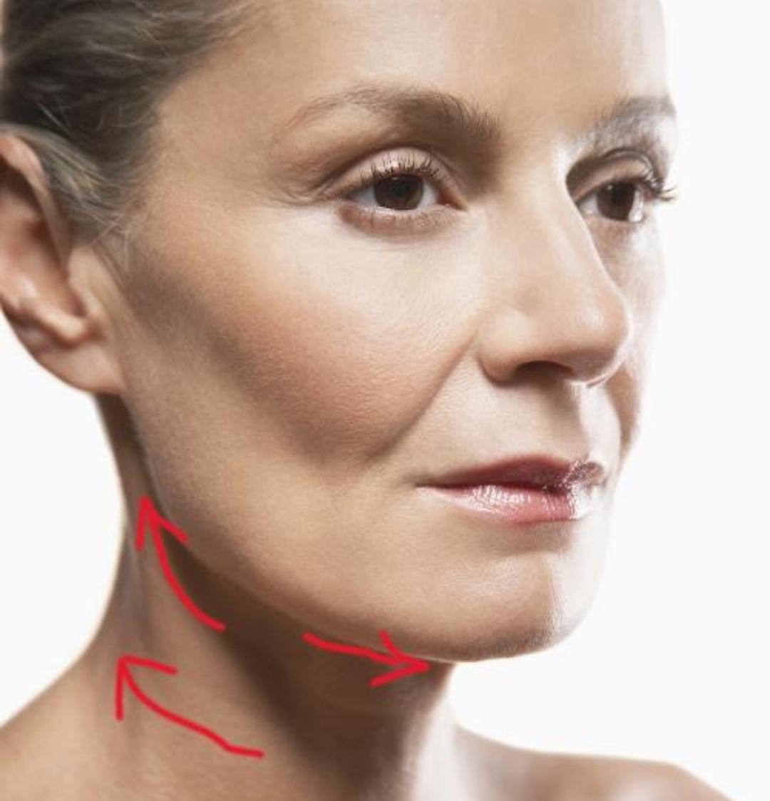 Neck Lift clinical or result imagery