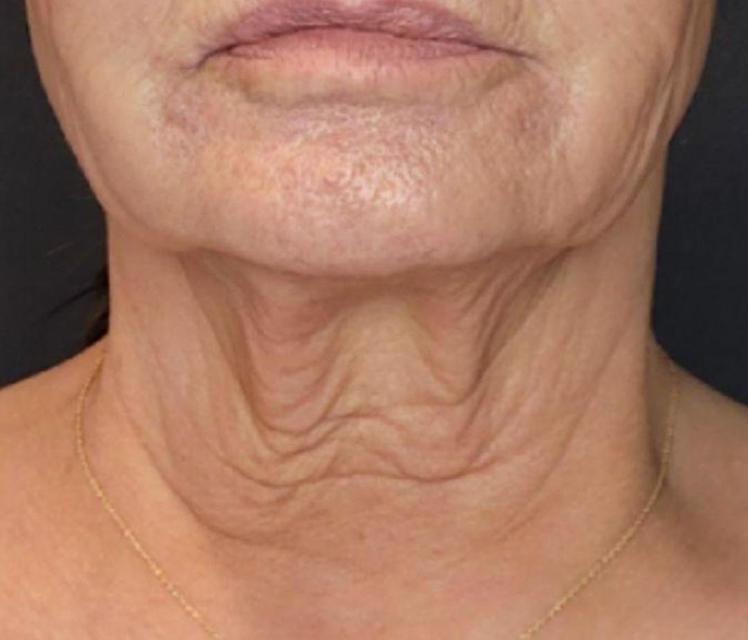 Neck Lift clinical or result imagery