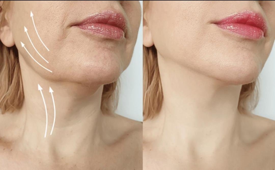 Neck Lift example from the practice media library