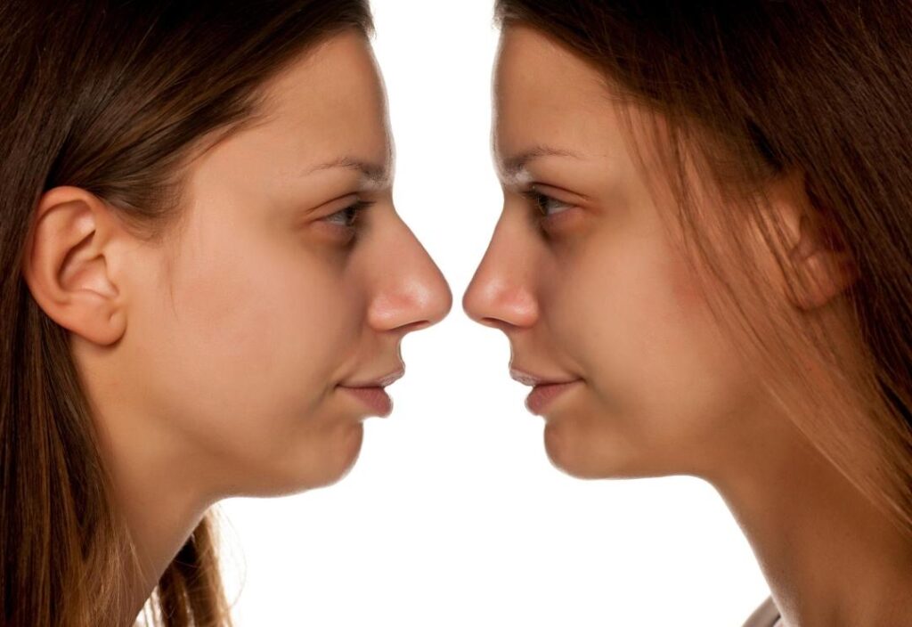 NOSE JOB_3