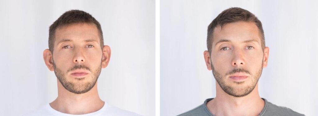 PROMINENT EARS_1