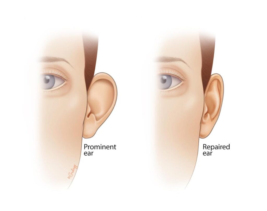 PROMINENT EARS_2
