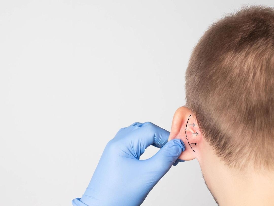 Editorial image representing prominent ear correction (otoplasty)
