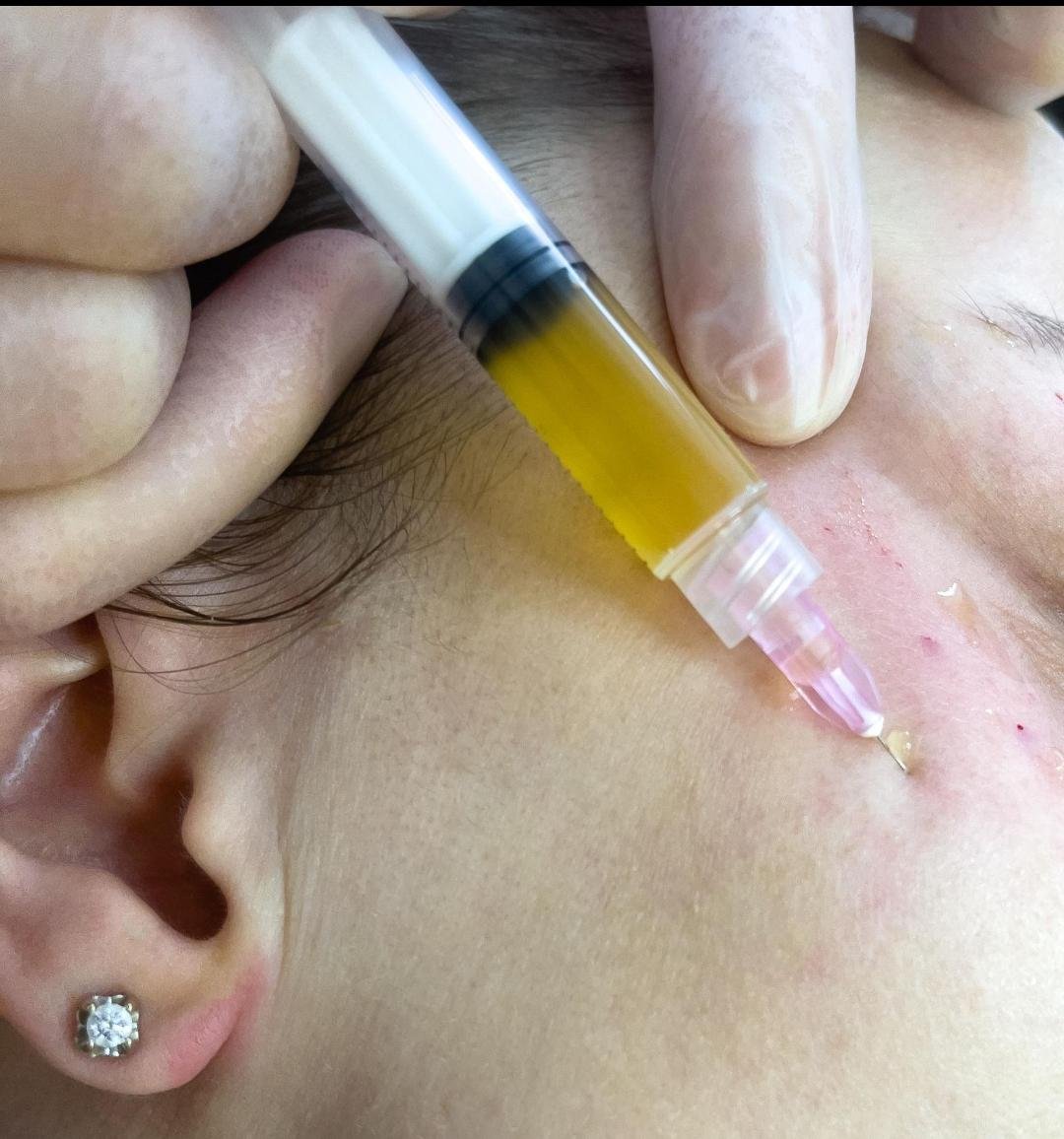 PRP Skin Rejuvenation clinical or result imagery