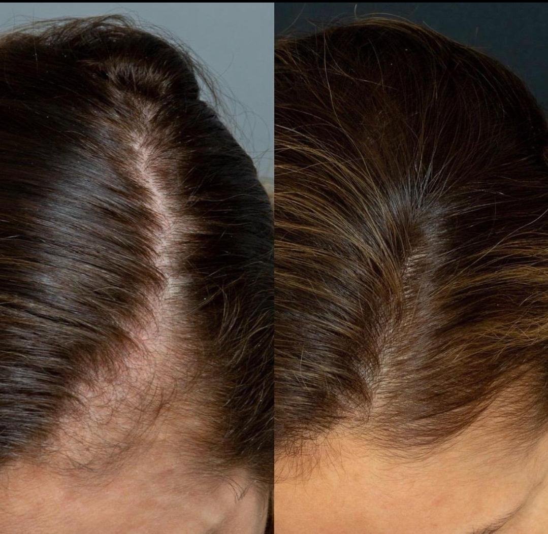 PRP for Hair Loss example from the practice media library