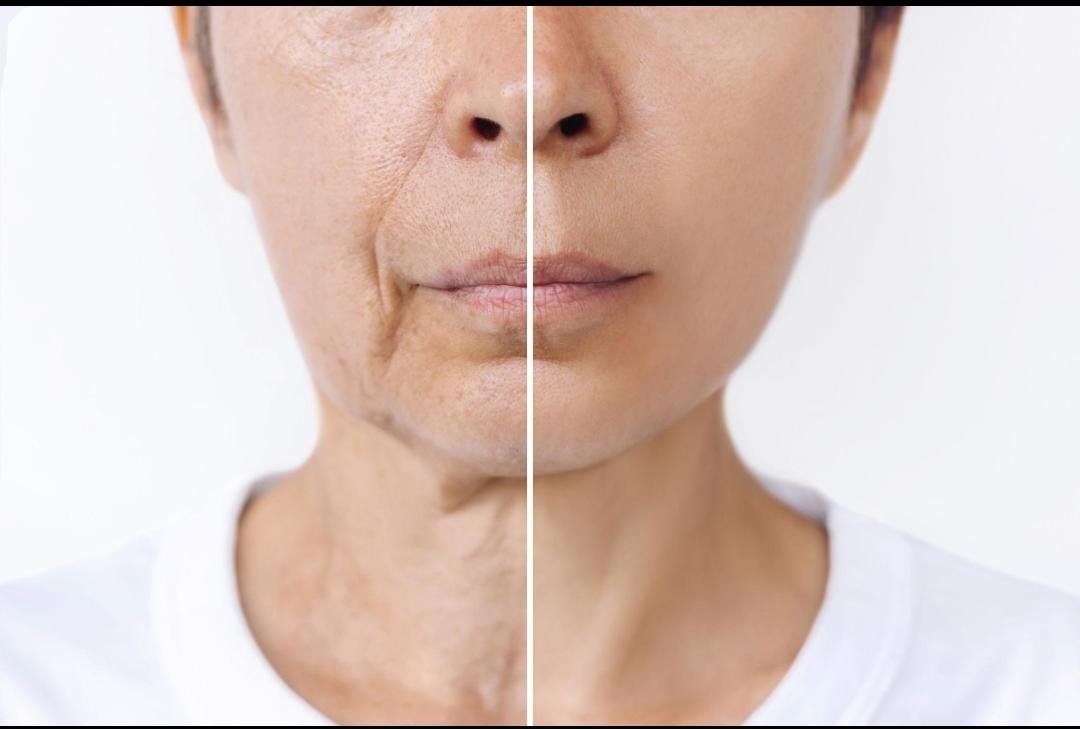 Thread Lift clinical or result imagery