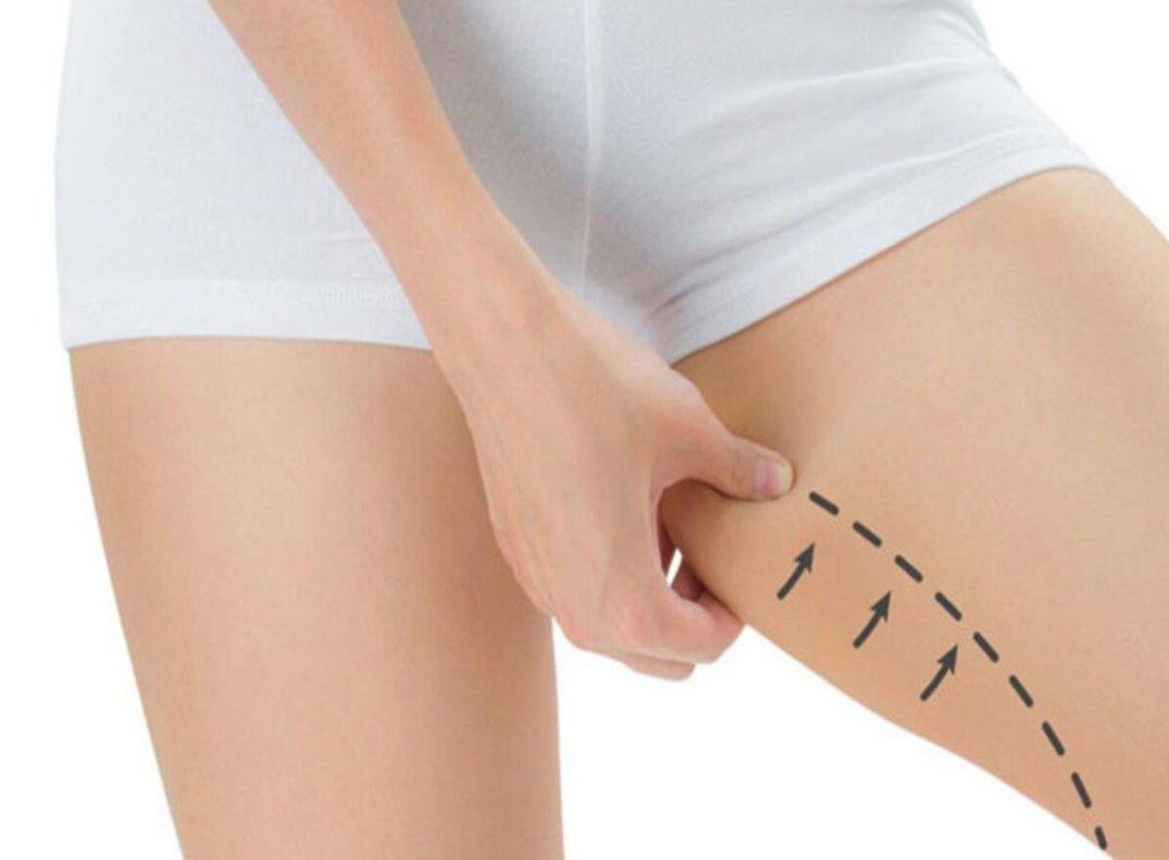Editorial image representing thigh lift (thighplasty)