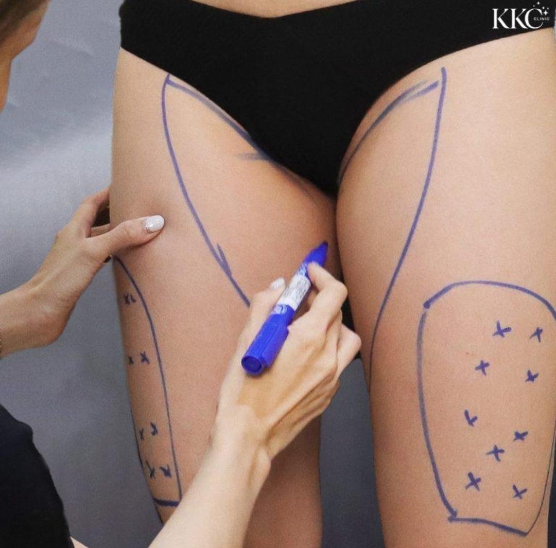 Thigh Lift (Thighplasty) clinical or result imagery