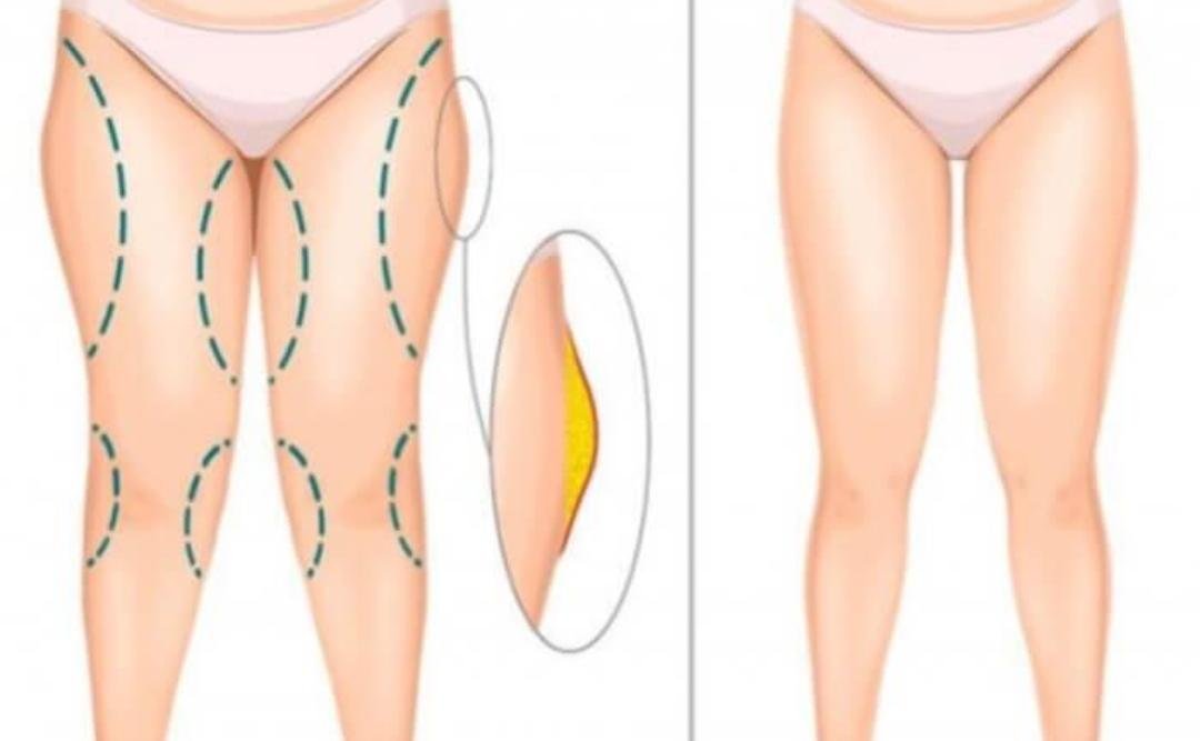 Thigh Lift (Thighplasty) clinical or result imagery