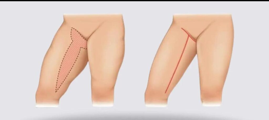 Thigh lift_3