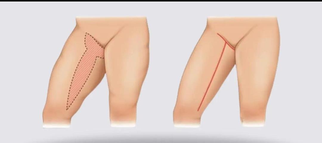 Thigh Lift (Thighplasty) example from the practice media library