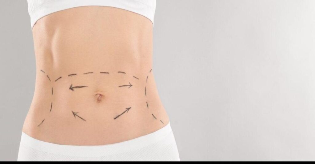 Tummy tuck_1