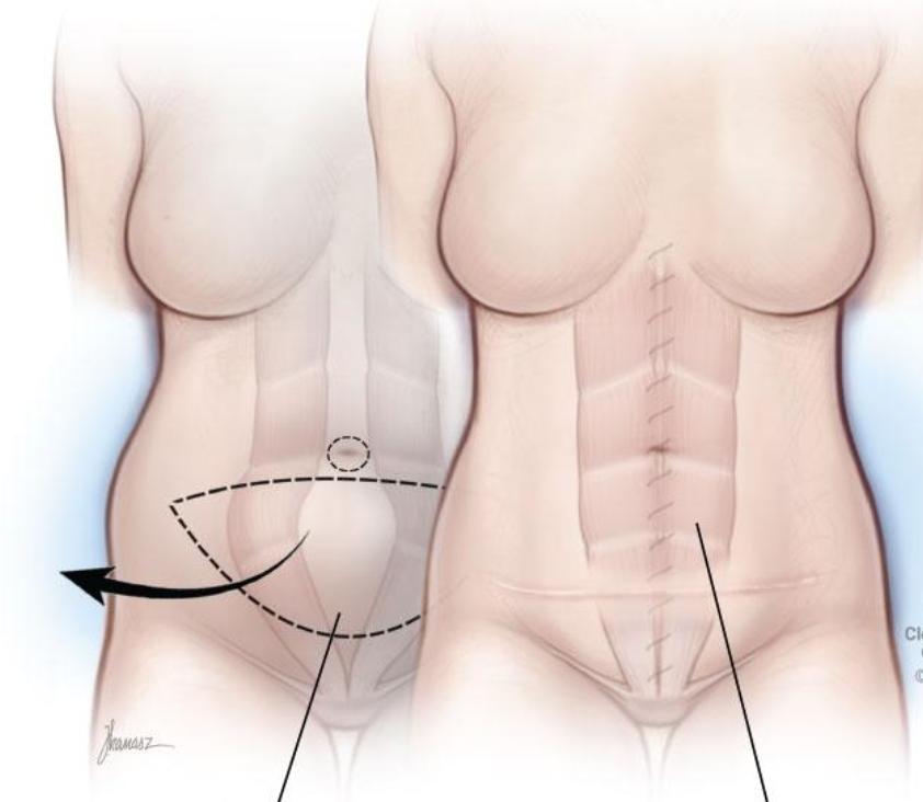 Tummy tuck_3
