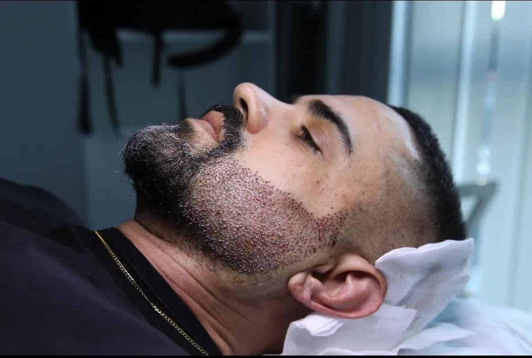 Beard Transplantation clinical or result imagery
