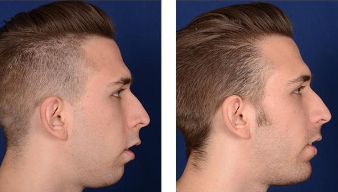 Chin & Jawline Contouring clinical or result imagery