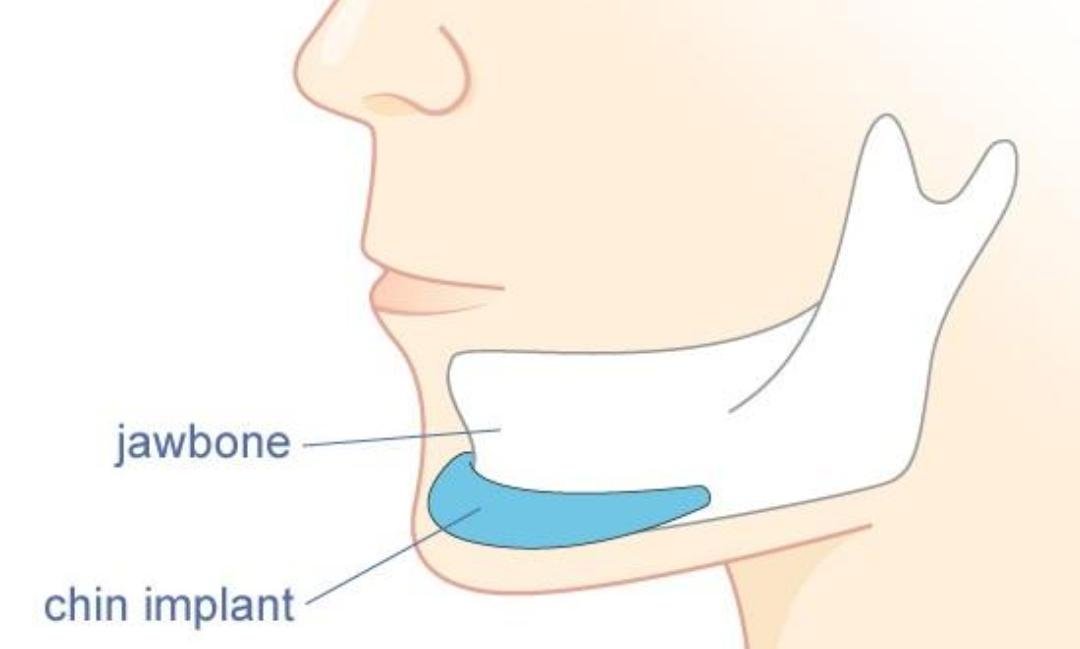 Chin & Jawline Contouring example from the practice media library