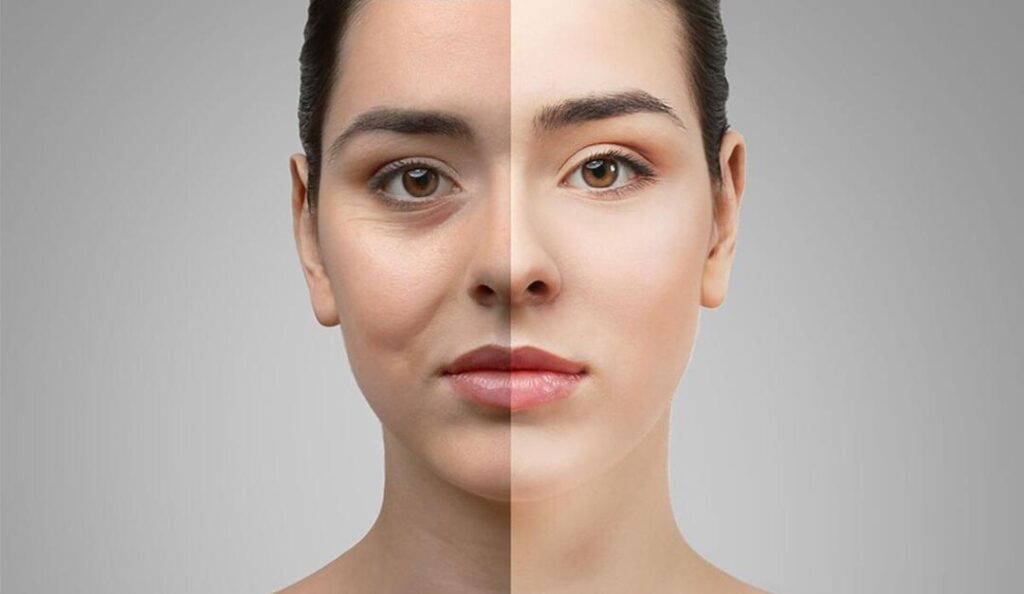 face fat grafting_3