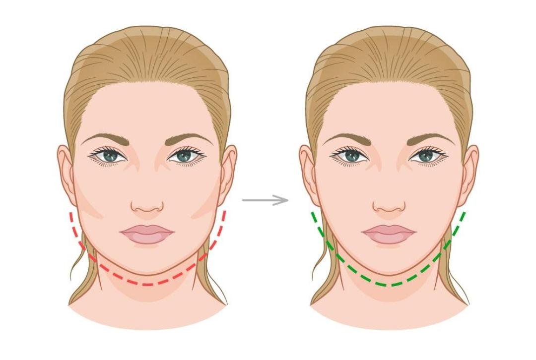 Face Slimming clinical or result imagery