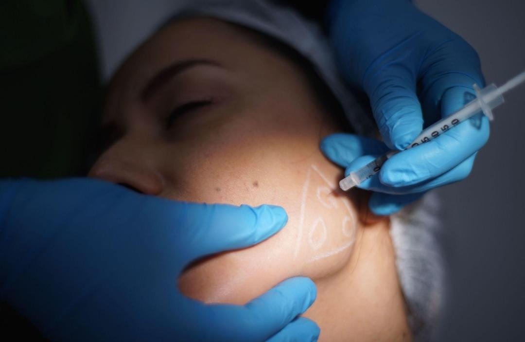 Face Slimming clinical or result imagery