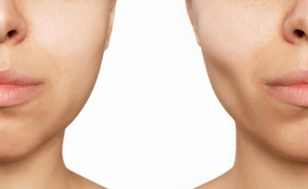 face slimming_3