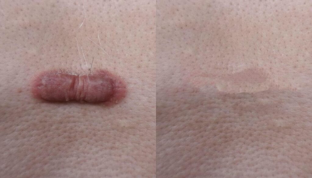 scar management_1