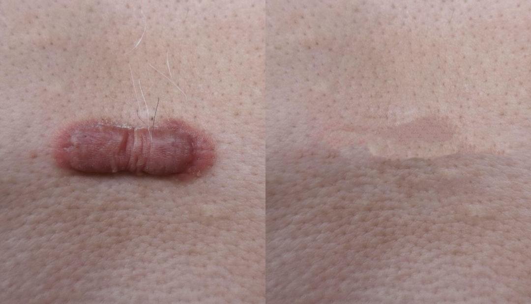 Scar Management clinical or result imagery