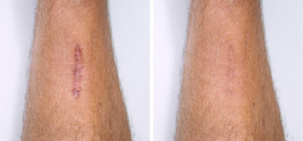 scar management_2
