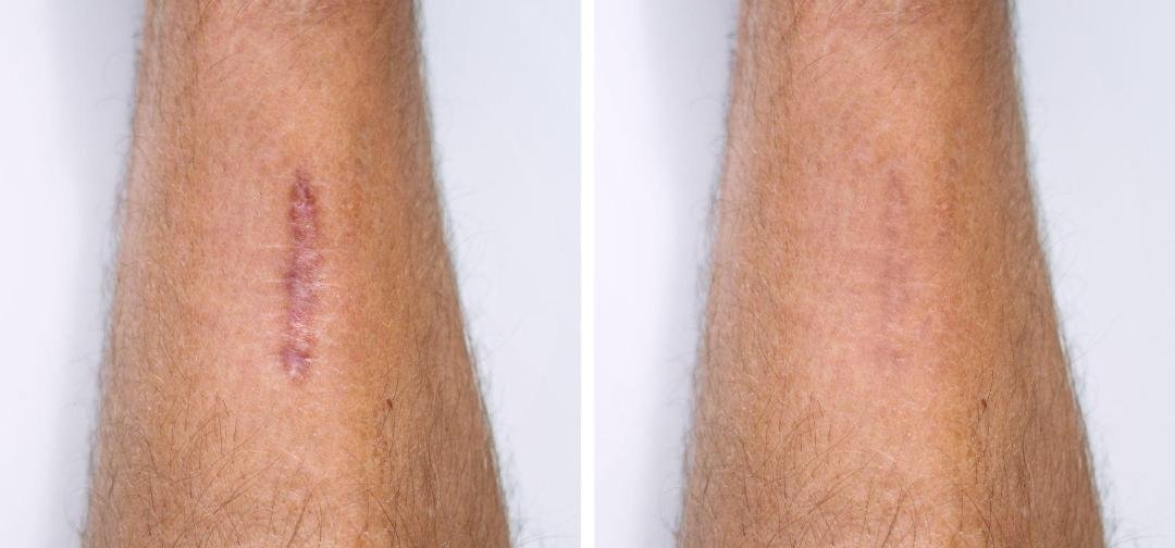 Scar Management clinical or result imagery