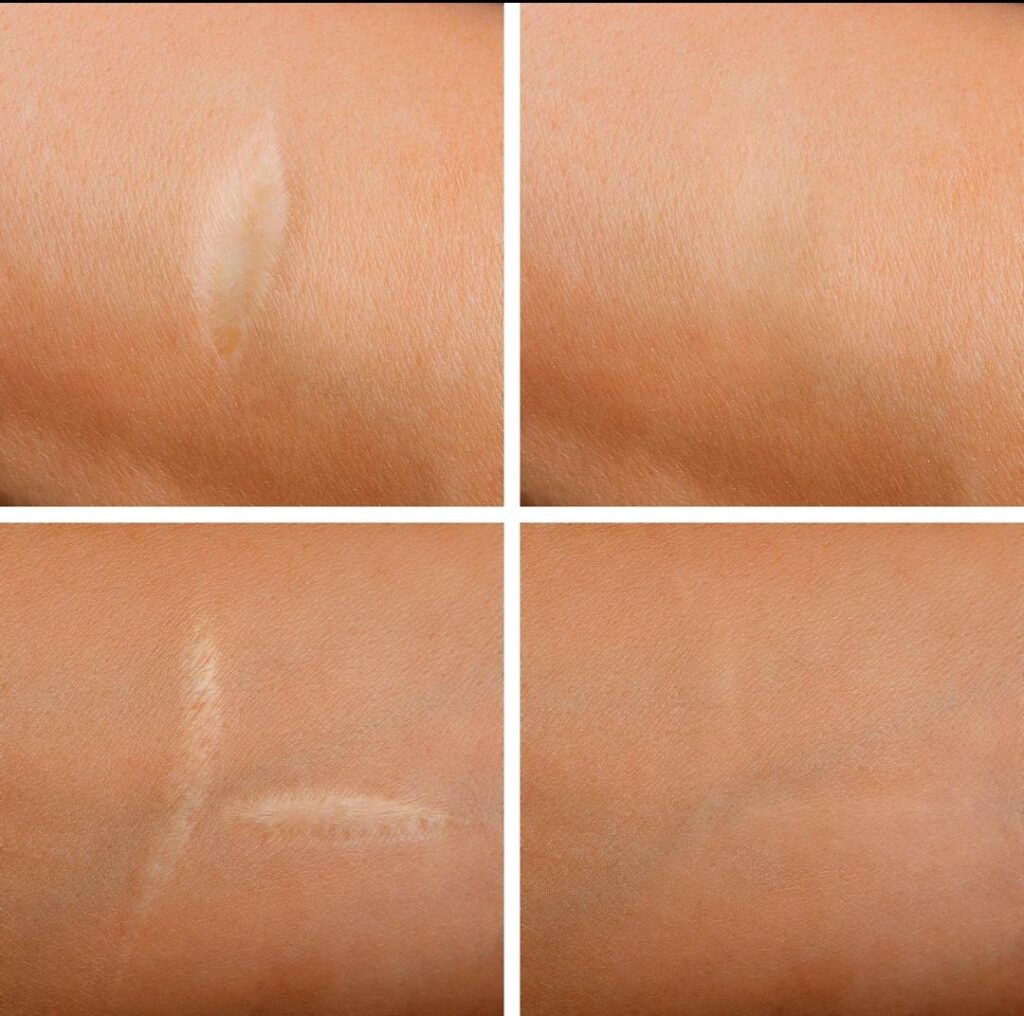 scar management_3