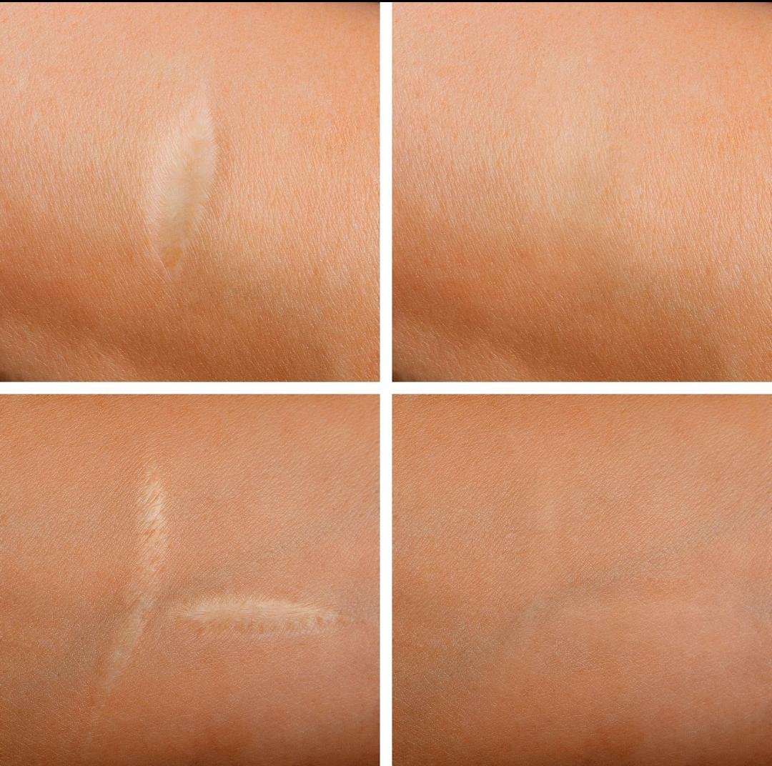 Scar Management example from the practice media library